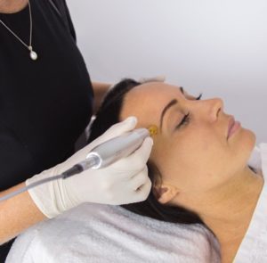 micro needling skin clinic tweed heads