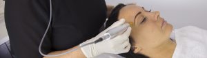 anti aging skin needling, on womans face