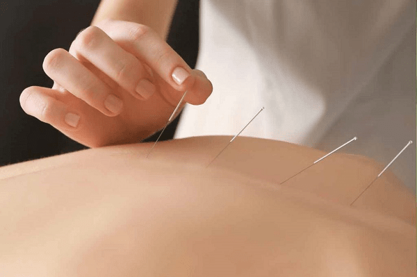 acupuncture and ACU