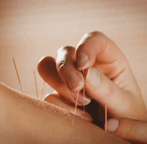fertility acupuncture near me tweed heads