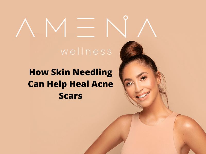 How Skin Needling Can Help Heal Acne Scars